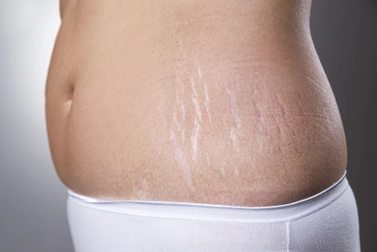 Penyebab Stretch Mark
