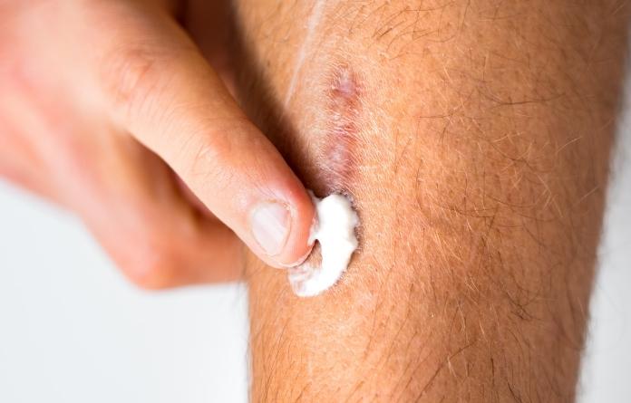 Obat Penghilang Luka